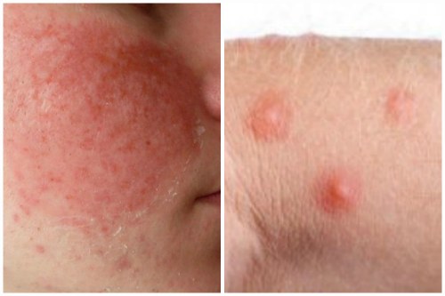 Аллергия и сыпь от подделки
