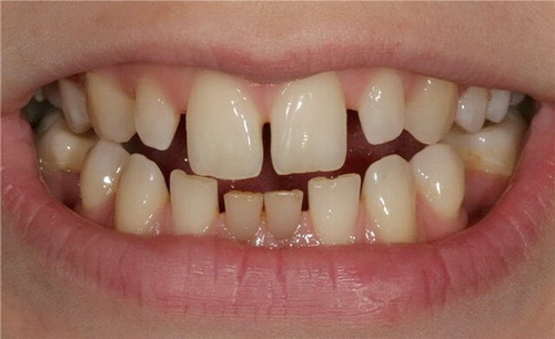 Пример образовавшихся щелей между зубами