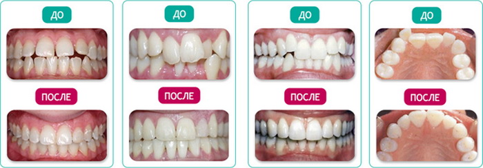 Результат после лечения зубов брекетами