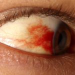 Операция по замене хрусталика глаза, особенности проведения, восстановительный период.