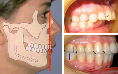 Опасность глубокого прикуса зубов