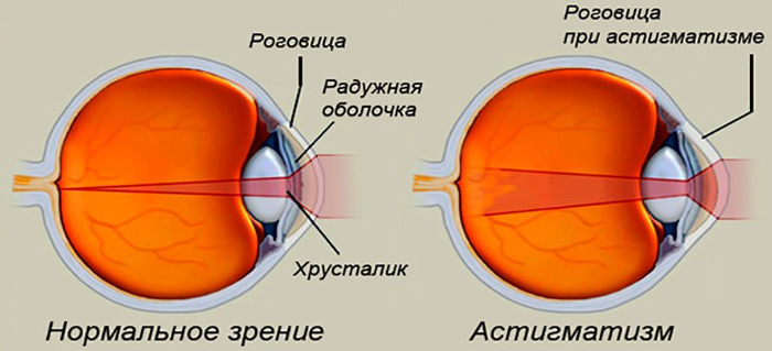 Что такое астигматизм глаз