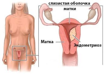 Схема эндометриоза