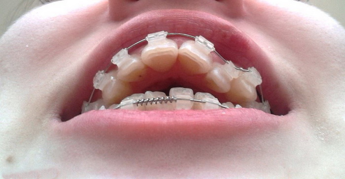 Как выглядит дистальный прикус зубов